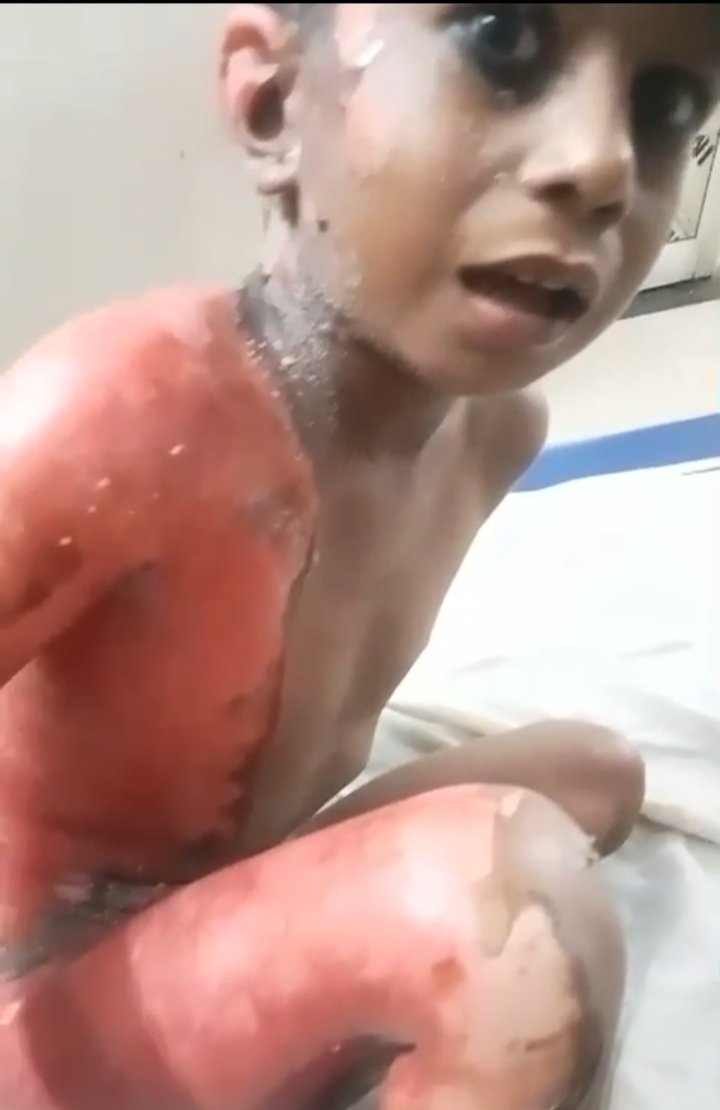Weeds in the happiness of marriage: six -year -old innocent fell in boiling sugar syrup, admitted to district hospital ... see VIDE